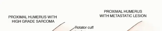 صورة توضيحية لـ جراحة نقائل عظم العضد: دليل شامل لاستعادة الوظيفة وتخفيف الألم في اليمن مع الأستاذ الدكتور محمد هطيف