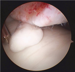 Illustration 6 for First Metatarsal Surgery: Expert Solutions for Foot & Ankle Pain