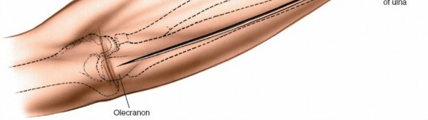 Illustration 44 for Mastering Approaches to the Upper Third of the Radius