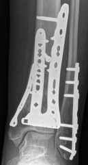 Illustration 36 for Decoding Pilon Fractures: Anterolateral and Medial Fragments Revealed