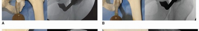 Illustration 11 for Periacetabular Osteotomy: Realigning your hip via the superior pubic ramus