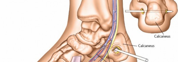 Illustration 36 for Expert Guide: Ulna and Wrist External Fixation Pin Placement