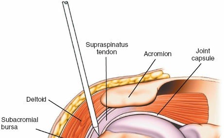 Illustration 6 for Step-by-Step Guide: Minimally Invasive Approach to the Proximal Humerus