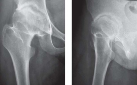 صورة طبية: مفصل الفخذ الصناعي قصير الجذع METHA: حلول مبتكرة للحفاظ على العظم في صنعاء مع الأستاذ الدكتور محمد هطيف