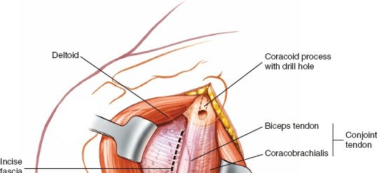 Illustration 20 for Essential Guide: Mastering Every Approach to the Shoulder