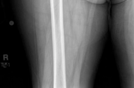 Illustration 2 for Analyzing a Hybrid Primary Hip Arthroplasty Patient Case