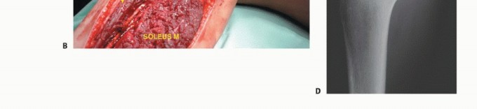 صورة طبية: استئصال أورام الشظية: دليل شامل للعلاج الحديث والحفاظ على الأطراف مع الأستاذ الدكتور محمد هطيف