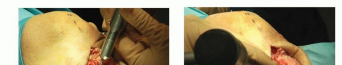 Illustration 13 for High Tibial Osteotomy: Realignment for Lasting Knee Pain Relief