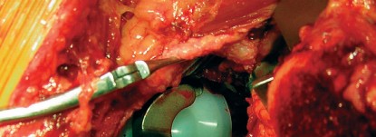 صورة طبية: طول عمر مكون الحُق الأسمنتي في مفصل الورك: مفتاح الاستقرار والديمومة مع الأستاذ الدكتور محمد هطيف في صنعاء