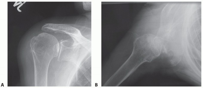 Illustration 7 for Restore Shoulder Function with Latissimus Dorsi Tendon Transfer