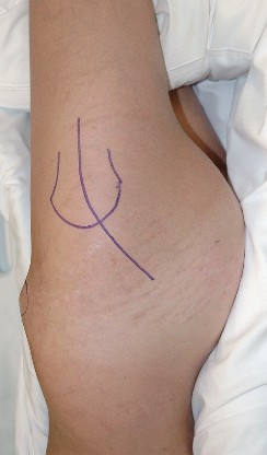 Illustration 13 for Unlock the Figure Posterior Approach to the Hip