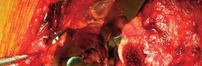 صورة طبية: طول عمر مكون الحُق الأسمنتي في مفصل الورك: مفتاح الاستقرار والديمومة مع الأستاذ الدكتور محمد هطيف في صنعاء