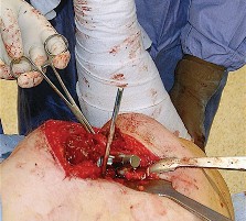 Illustration 54 for Unlock the Figure Posterior Approach to the Hip