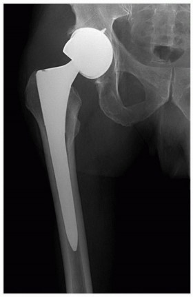 Mastering Revision THA: Strategies for Adverse Local Tissue Challenges