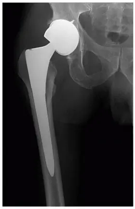 صورة توضيحية لـ إتقان مراجعة استبدال مفصل الورك: استراتيجيات تحديات الأنسجة المحلية الضارة