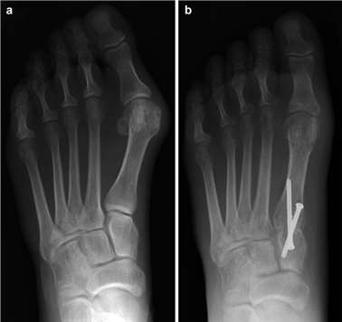 Illustration 65 for First Metatarsal Surgery: Expert Solutions for Foot & Ankle Pain