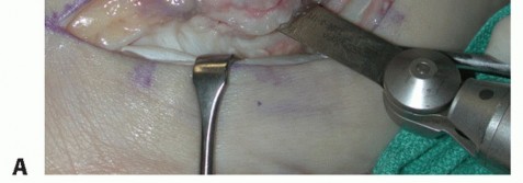 Illustration 35 for Beyond Primary Repair: Solutions for Peroneal Tendon Subluxation