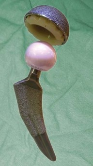 صورة توضيحية لـ تقنية الجذع القصير لاستبدال مفصل الورك الكلي: نهج الأستاذ الدكتور محمد هطيف لتدخل جراحي أقل ونتائج أفضل