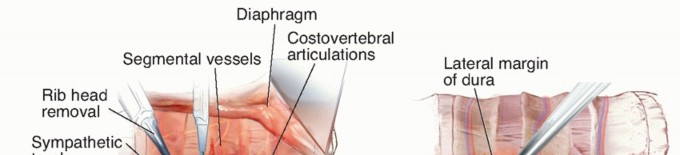 Anterior Thoracic Corpectomy: Decompression, Stabilization, Fusion