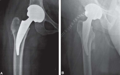 صورة طبية: مفصل الفخذ الصناعي قصير الجذع METHA: حلول مبتكرة للحفاظ على العظم في صنعاء مع الأستاذ الدكتور محمد هطيف