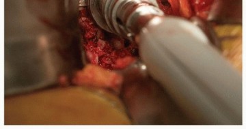 صورة طبية: تثبيت مفصل الورك بدون أسمنت: دليل شامل لمرضى استبدال الورك مع الأستاذ الدكتور محمد هطيف