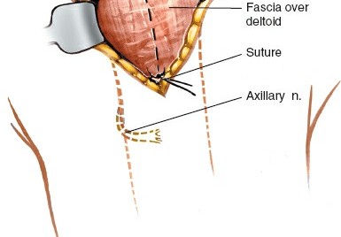 Illustration 104 for Essential Guide: Mastering Every Approach to the Shoulder