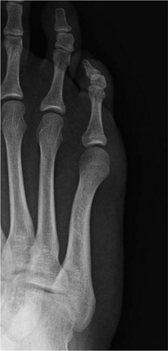 Illustration of fifth metatarsal head - Dr. Mohammed Hutaif