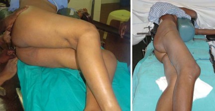 صورة طبية: استبدال مفصل الورك الكلي لالتهاب المفاصل الروماتويدي اليفعي: استعادة الحركة والأمل مع الأستاذ الدكتور محمد هطيف في صنعاء