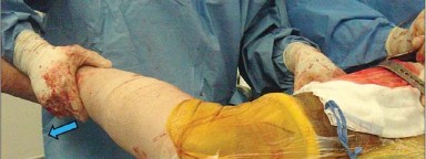 Illustration 25 for Mastering Soft Tissue Balancing for Optimal THR Outcomes