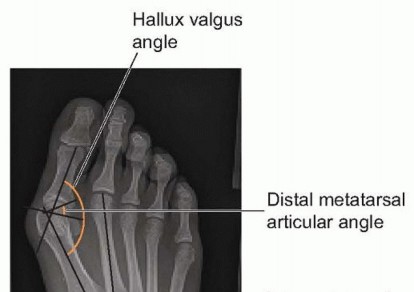 Illustration of correction of juvenile - Dr. Mohammed Hutaif