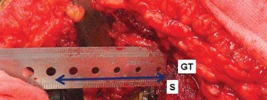 Illustration 14 for Mastering Soft Tissue Balancing for Optimal THR Outcomes