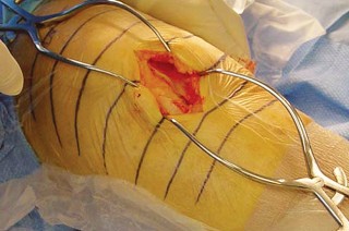 Illustration 21 for Knee Arthroplasty: Avoiding Pitfalls & Benefiting from UKA