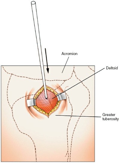 Illustration 2 for Step-by-Step Guide: Minimally Invasive Approach to the Proximal Humerus