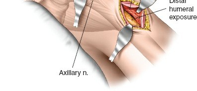 Illustration 115 for Essential Guide: Mastering Every Approach to the Shoulder