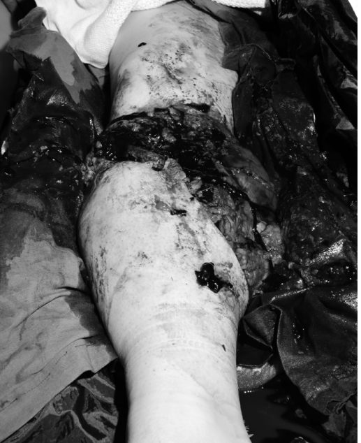 Mangled Extremity: Master This Trauma Case Answer