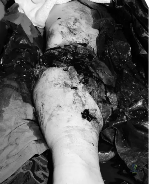 Illustration of trauma case answer - Dr. Mohammed Hutaif