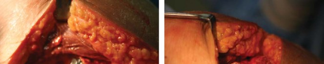 صورة طبية: مفصل الفخذ الصناعي قصير الجذع METHA: حلول مبتكرة للحفاظ على العظم في صنعاء مع الأستاذ الدكتور محمد هطيف