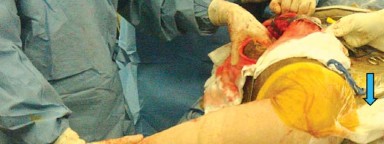 Illustration 18 for Mastering Soft Tissue Balancing for Optimal THR Outcomes