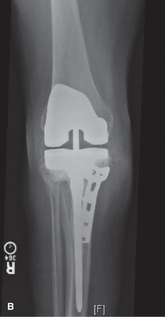 Illustration 2 for Painful Total Knee: Best Treatment Strategies for Complex Cases