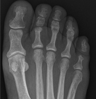 Rocker Bottom Modification: Relieve Midfoot Pain Without Surgery