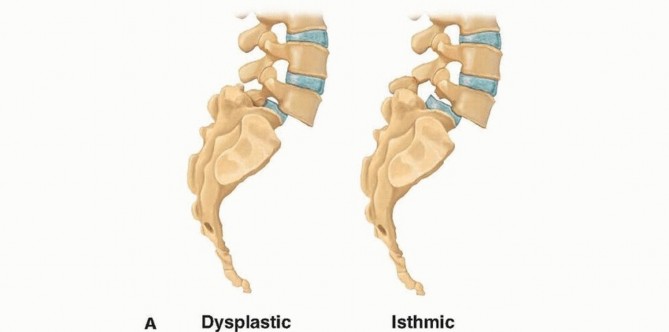 Mastering High-Grade Spondylolisthesis: Posterolateral and Interbody Fusion