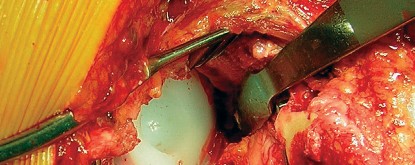 صورة طبية: طول عمر مكون الحُق الأسمنتي في مفصل الورك: مفتاح الاستقرار والديمومة مع الأستاذ الدكتور محمد هطيف في صنعاء