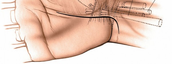 Illustration 241 for Essential Surgical Approaches: Uncover Every Aspect of the Wrist