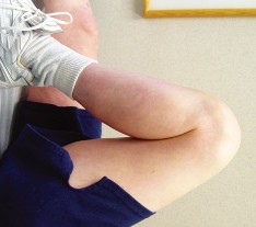 Illustration 83 for Unicompartmental Knee Arthroplasty: Master decisions with this b c figure guide.