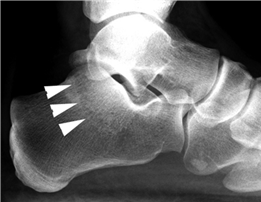Illustration 35 for First Metatarsal Surgery: Expert Solutions for Foot & Ankle Pain