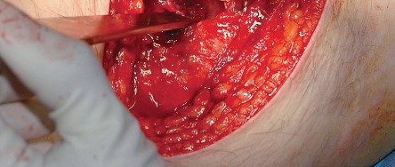 Illustration 36 for Unlock the Figure Posterior Approach to the Hip