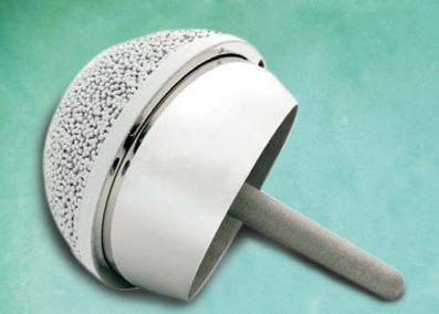 Minimizing Risks: Computer Navigation in Hip Resurfacing Arthroplasty