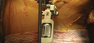 Illustration 21 for Posterior Stabilized Technique: Essential Insights for TKA Success