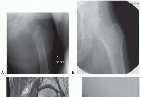 ORIF for Peritrochanteric Hip Fractures: Achieve Stable Mobility