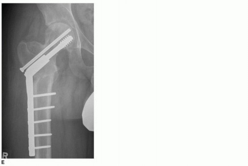 Illustration 29 for Periacetabular Osteotomy: Realigning your hip via the superior pubic ramus